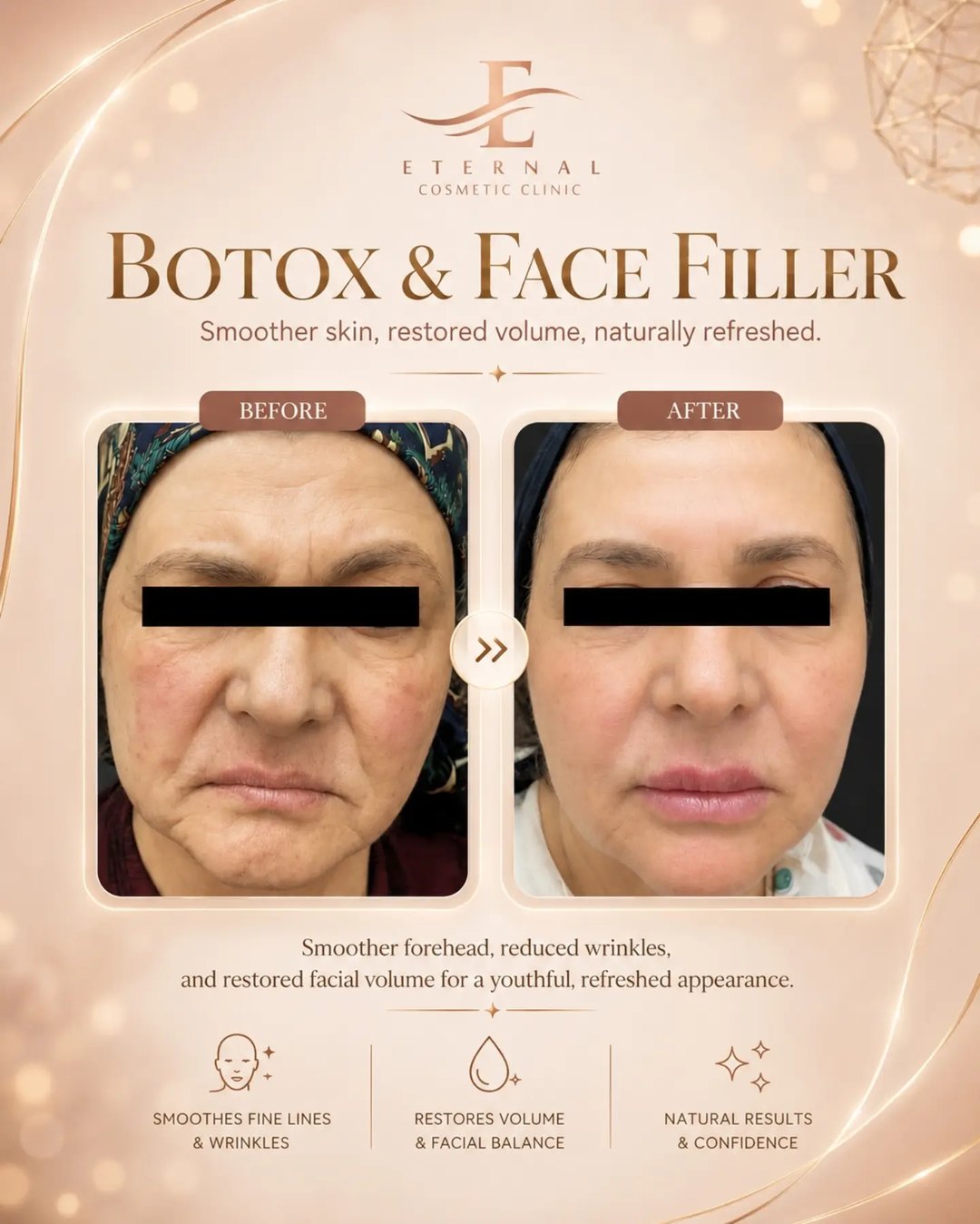 Botox & face filler: smoother skin, restored volume