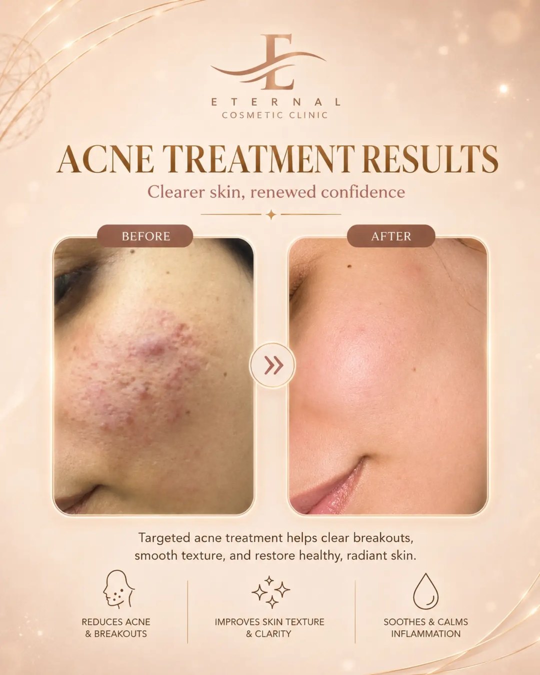Acne treatment: clearer skin starts with the right plan