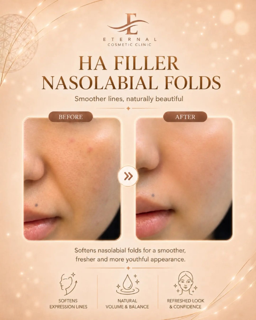 HA filler for smile lines: softer, naturally balanced