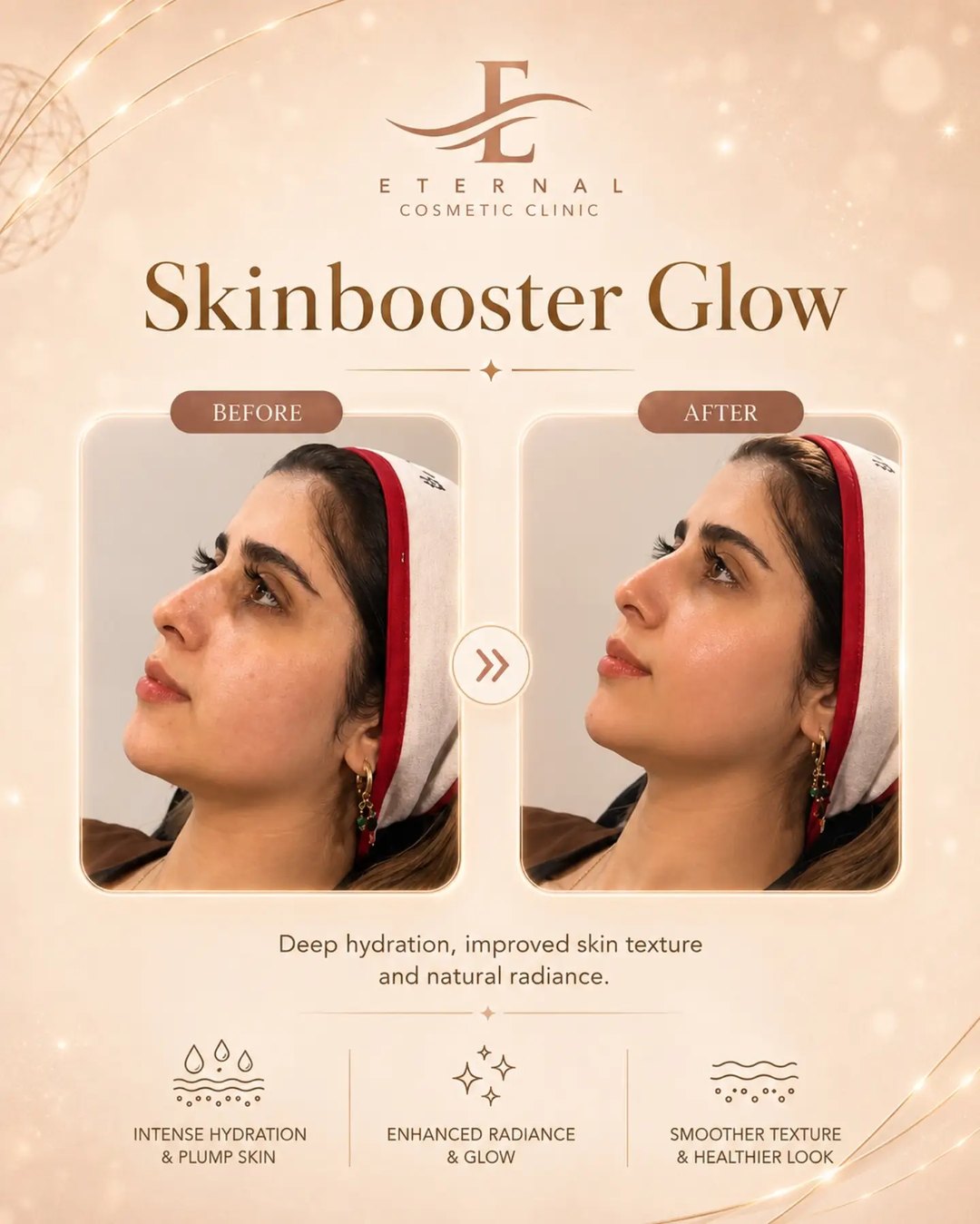 Skinbooster glow result